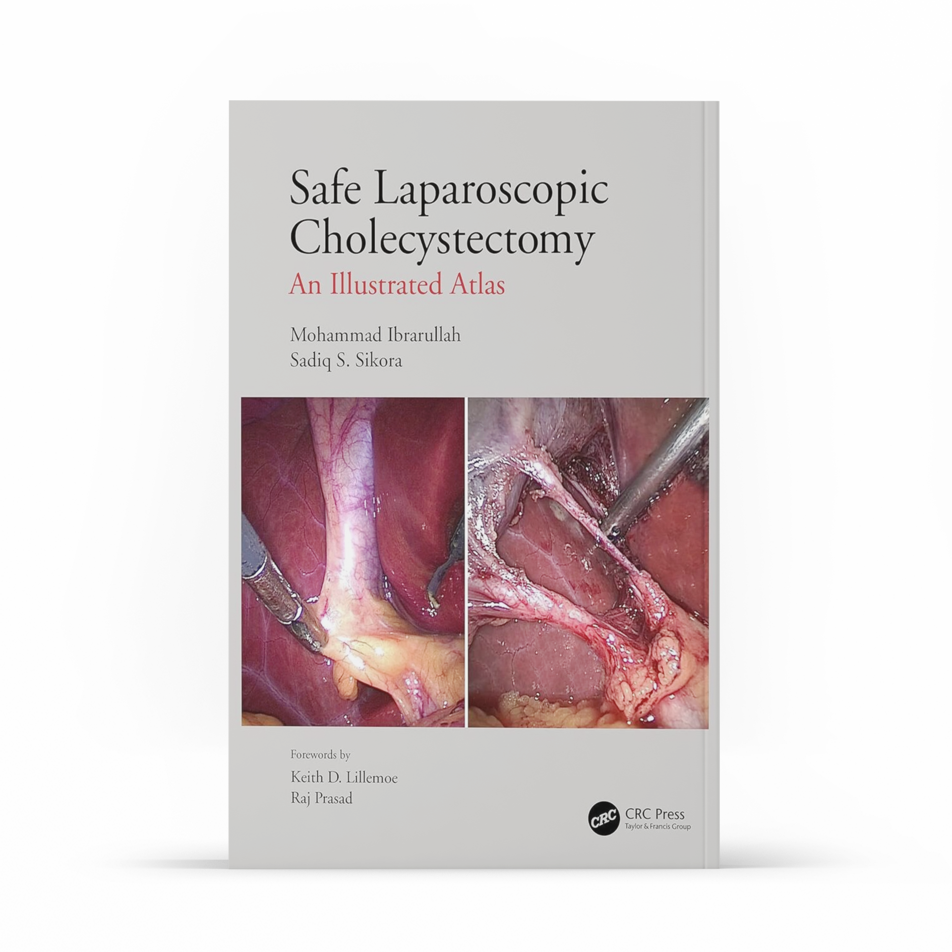 Safe Laparoscopic Cholecystectomy: An Illustrated Atlas