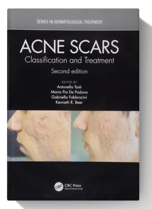 Acne Scars: Classification and Treatment, Second Edition (Series in Dermatological Treatment)